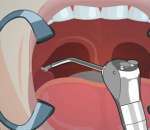 Хирургия: гланды – Tonsil Surgery