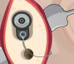 Операционная: ушная хирургия – Operate Now: Ear Surgery