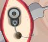 Логические Операционная: ушная хирургия – Operate Now: Ear Surgery